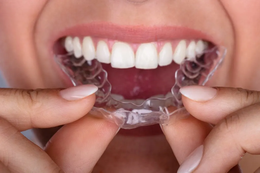 Woman inserts invisible dental splint - Closeup