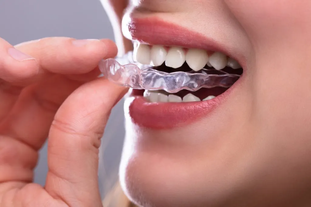 Kobieta zakłada niewidoczną szynę dentystyczną - zbliżenie