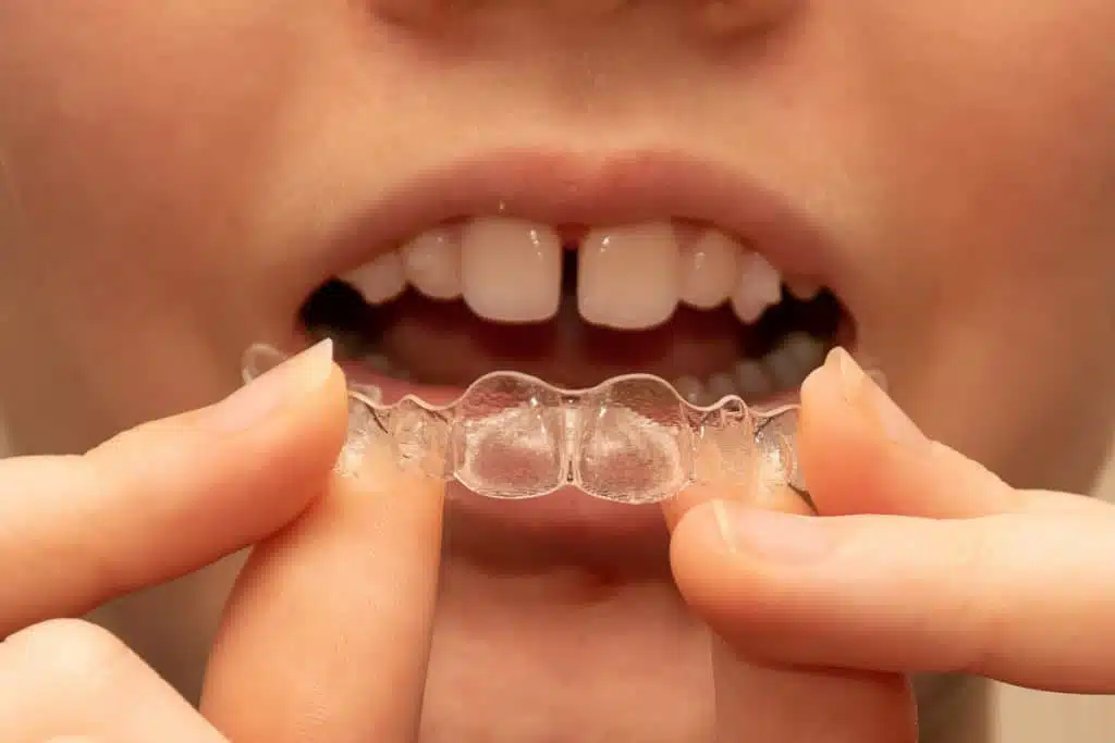Invisible braces: How does Invisalign work? 2 Woman puts invisible braces - how does Invisalign work?
