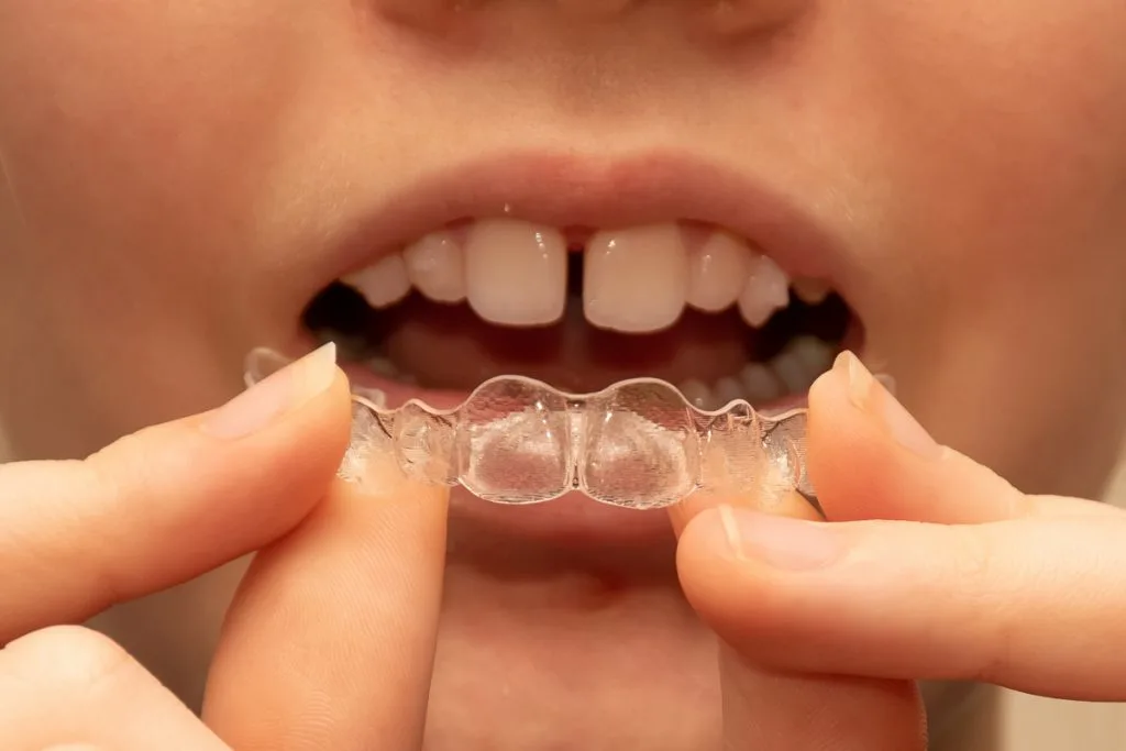 Una mujer se coloca ortodoncia invisible: ¿cómo funciona Invisalign?
