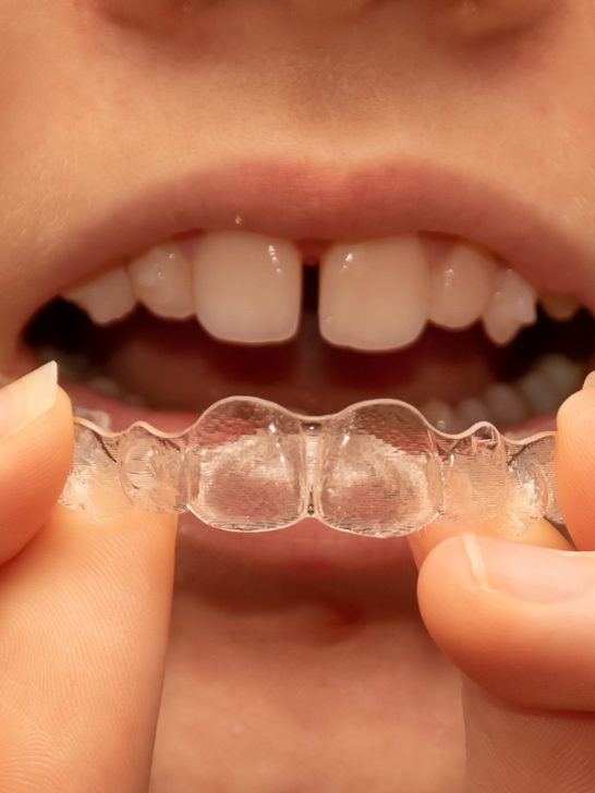 Invisible braces: How does Invisalign work?