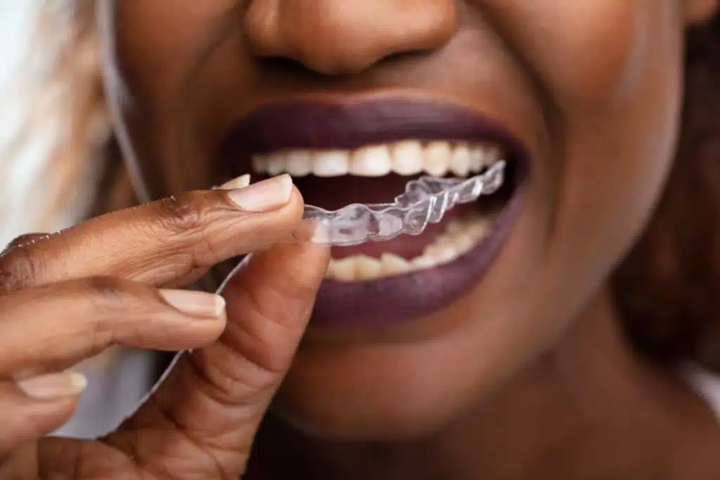 Woman inserts aligner - Closeup