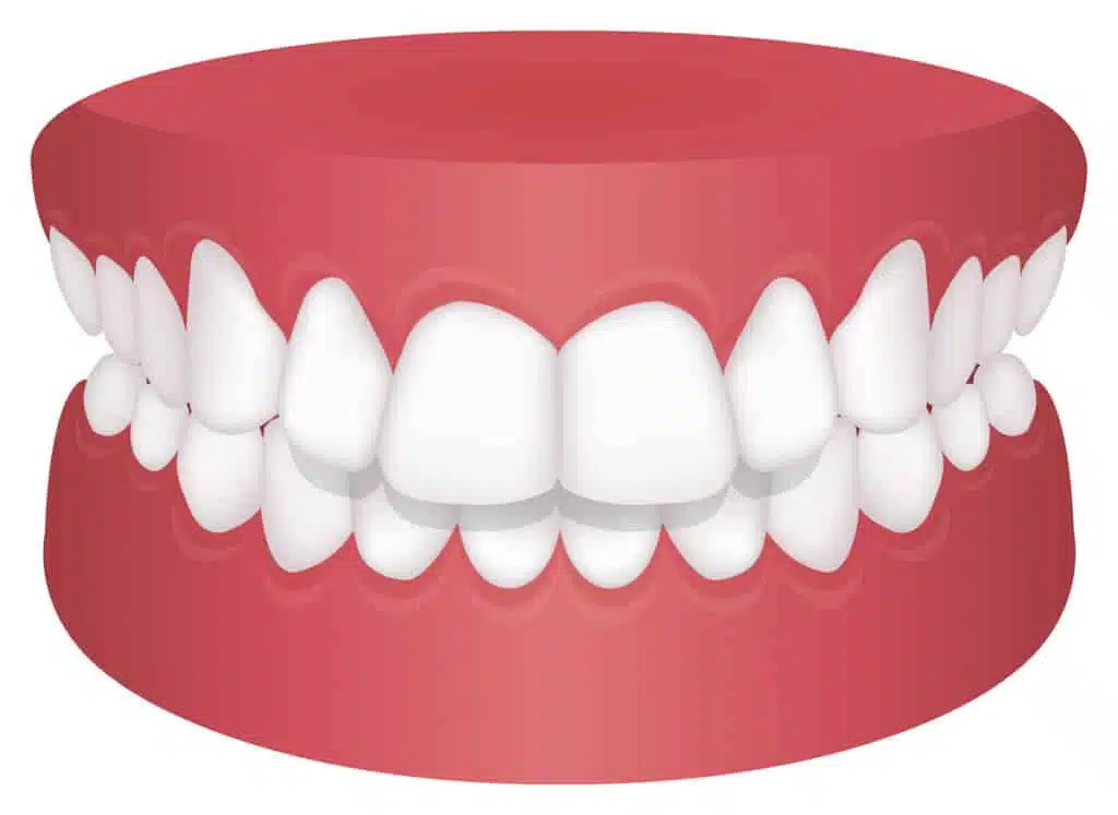 Overbite: What is it actually and how does the treatment proceed? 3 Overbite - malocclusions