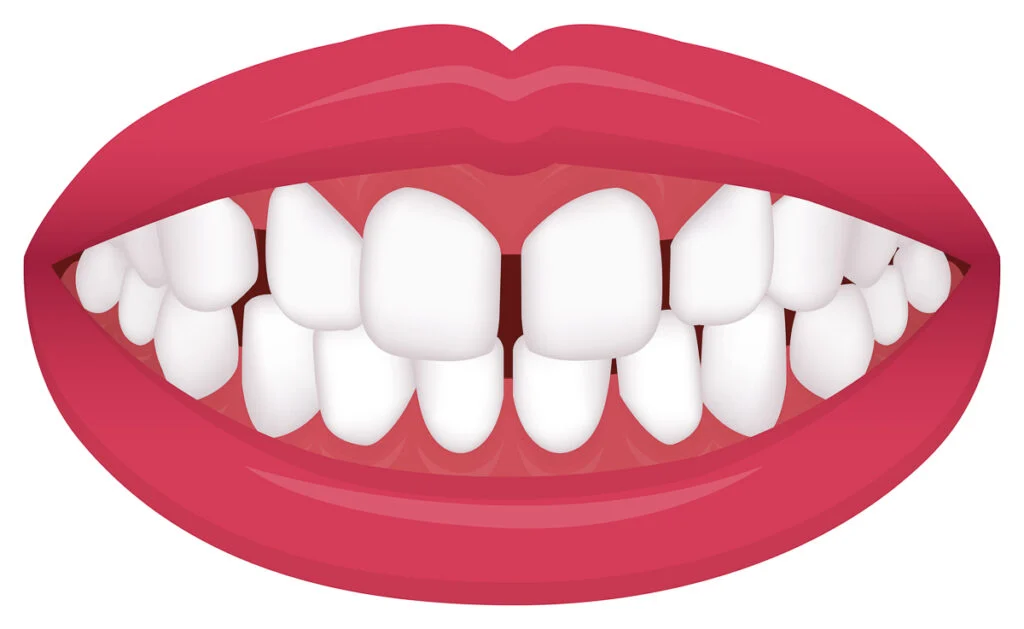 Szczeliny między zębami - diastema - wady zgryzu