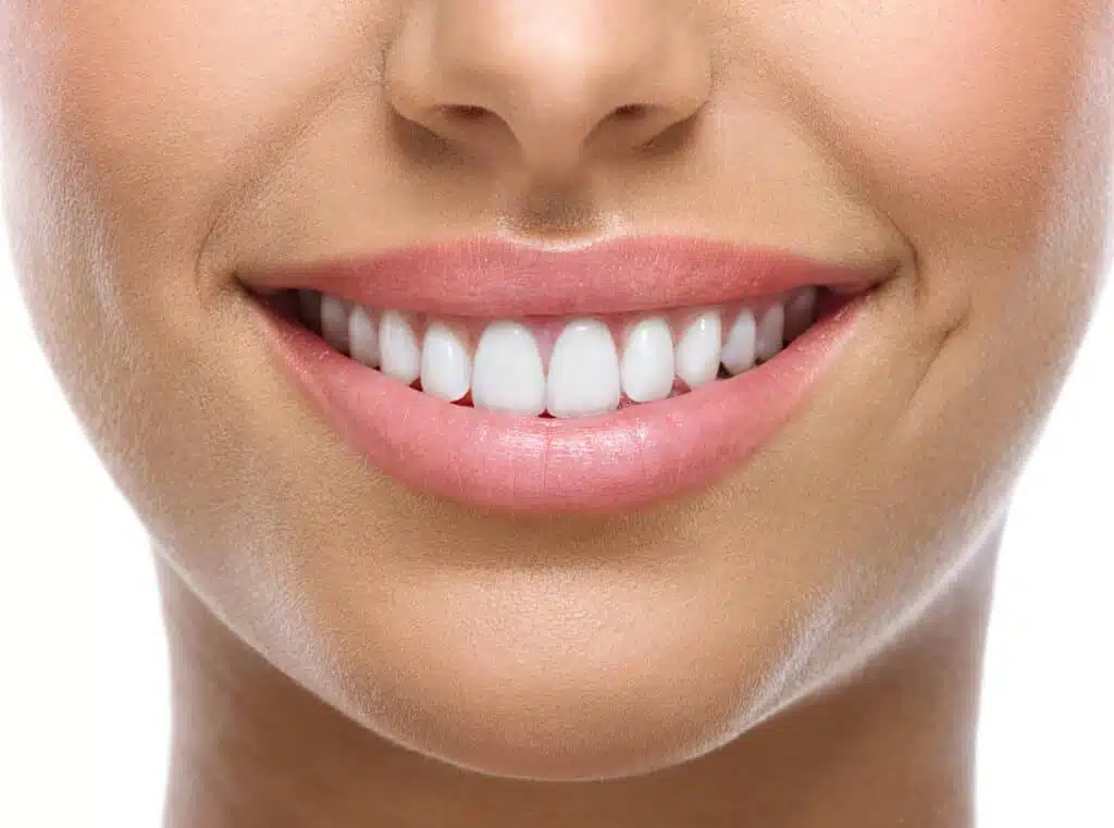 Small helpers, big effect: How do brace elastics work? 2 Woman smiles with bright white teeth - how do braces work?
