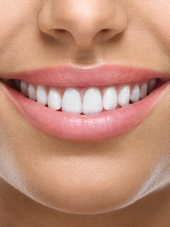 Frau lächelt mit strahlend weißen Zähnen - wie funktionieren Zahnspangengummis?