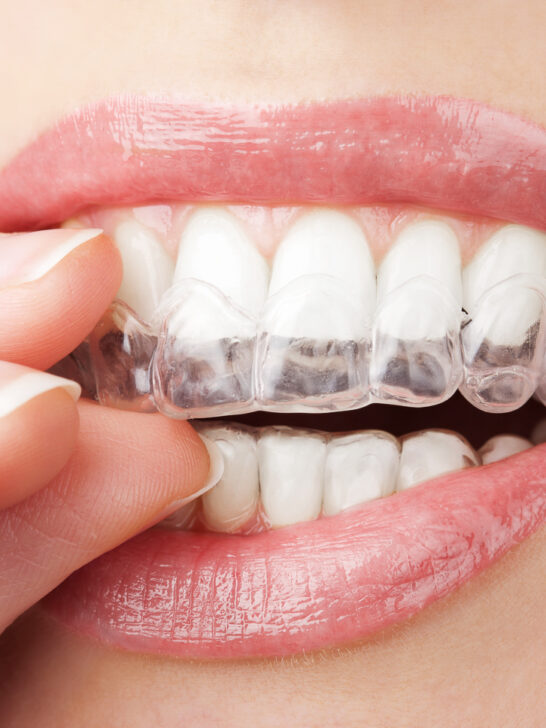 Invisalign i7: The solution for slight tooth misalignments