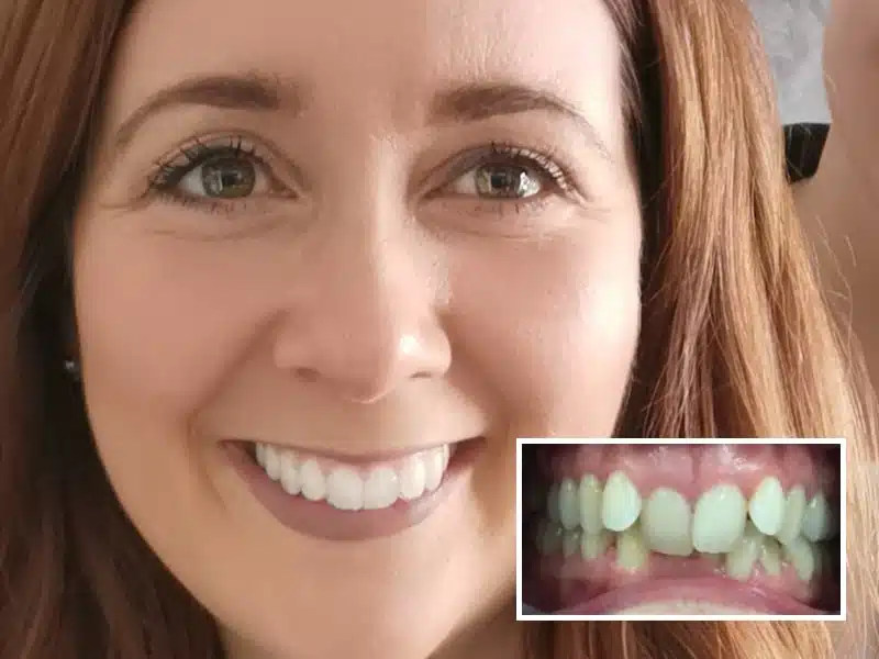 Overbite: What is it actually and how does the treatment proceed? 7 DrSmile before and after pictures: Overbite