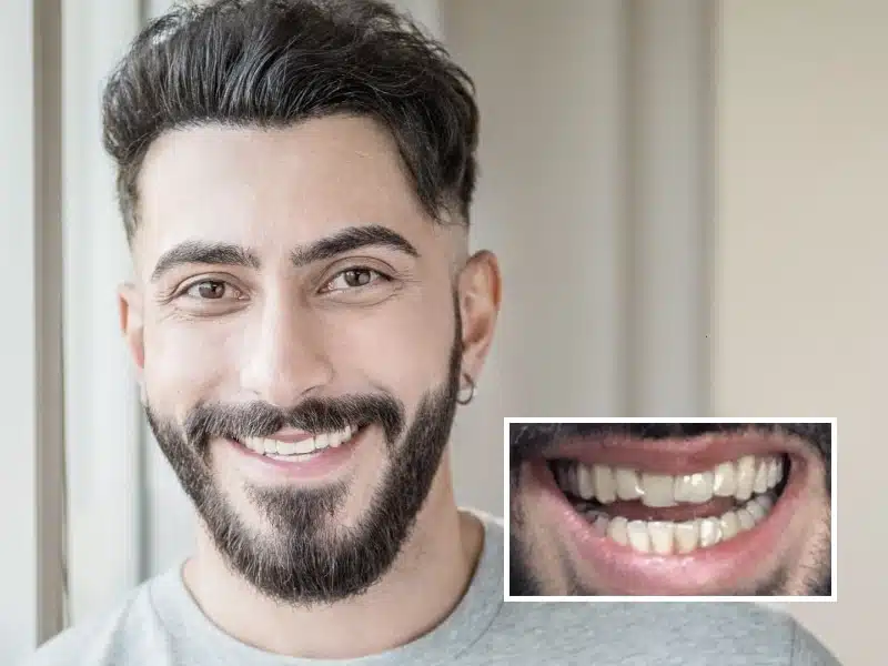 DrSmile vorher/nachher: Bilder und Erfolgsgeschichten