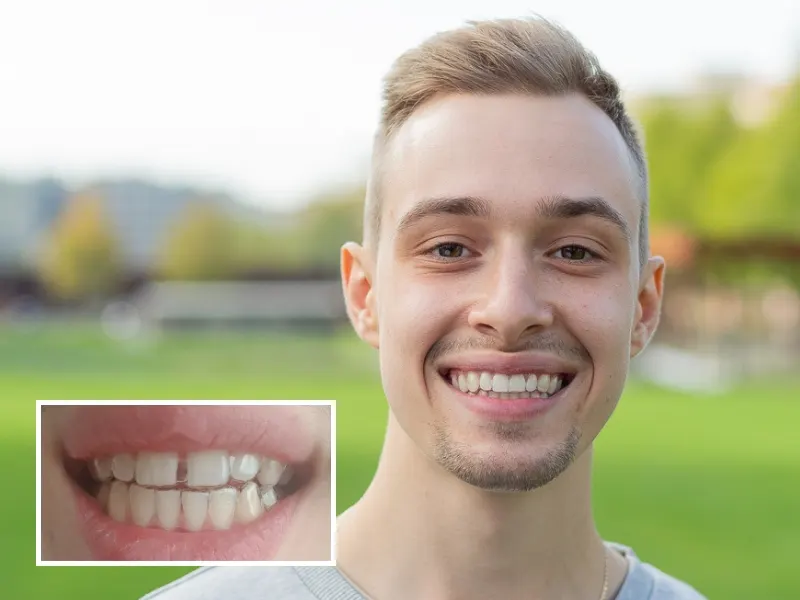 Fotos de antes y después de DrSmile: Espacio entre dientes (diastema)