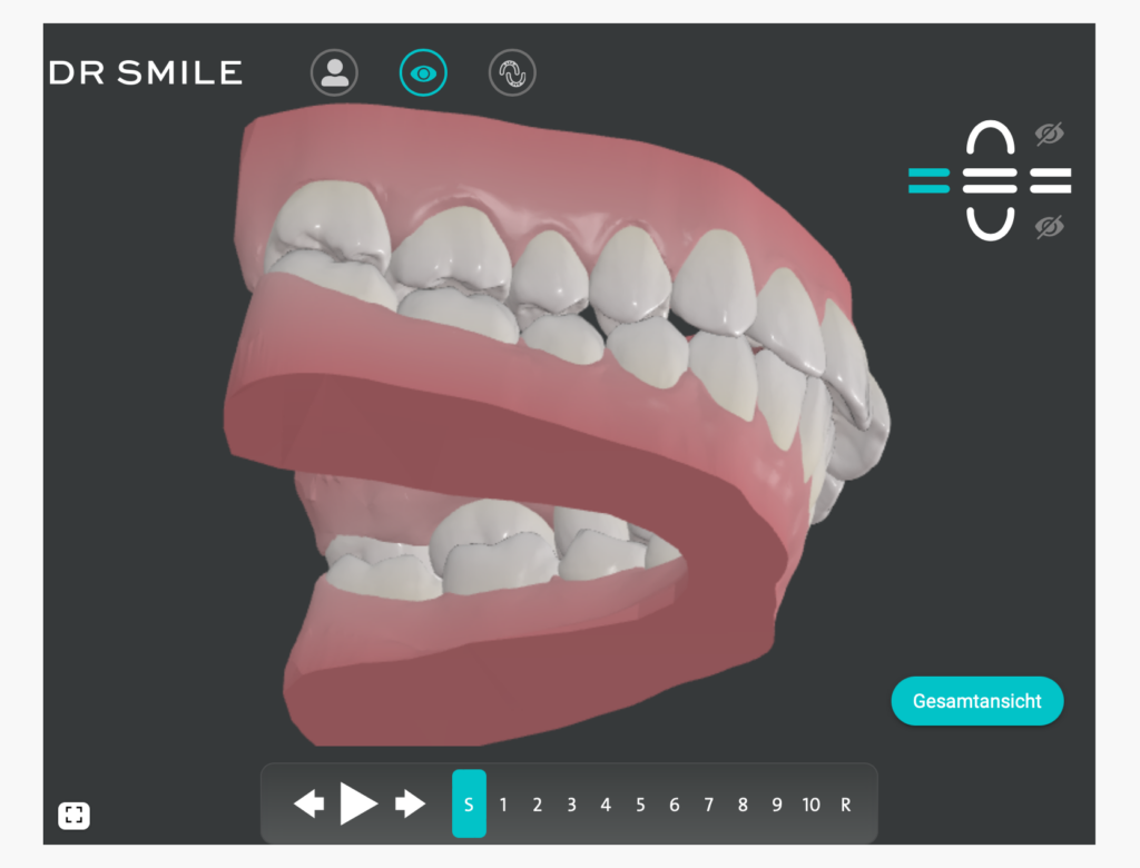 DrSmile treatment plan with 3D simulation