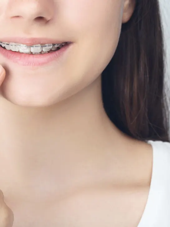 Soft Foods for Braces – What can I eat without any Trouble?