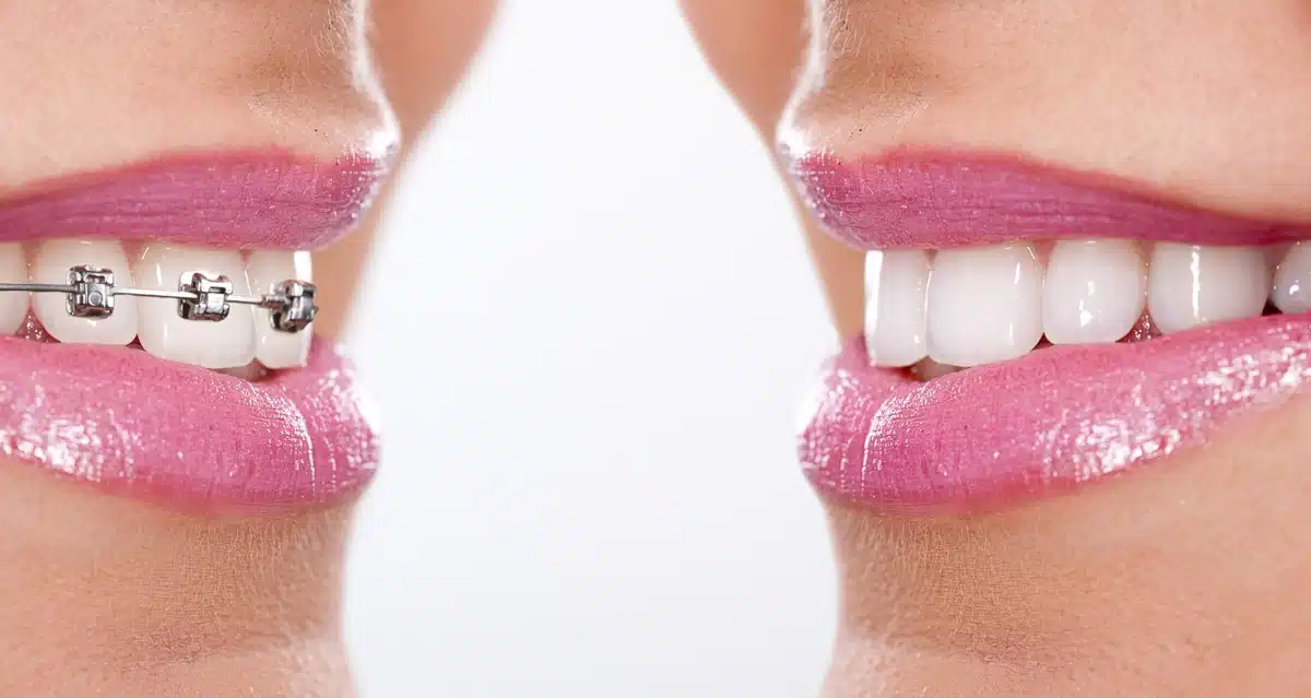 Fixed or loose braces: what are the advantages, disadvantages and costs?