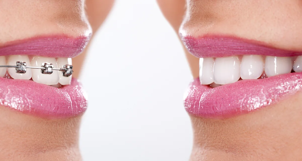Ung kvinna med och utan tandställning - närbild - fast eller lös tandställning