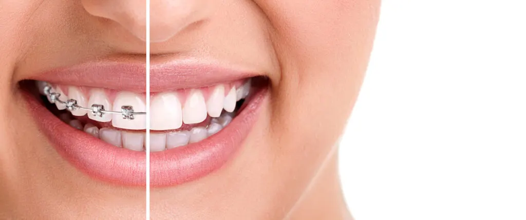 Kobieta uśmiechająca się z aparatem ortodontycznym i bez niego -  
