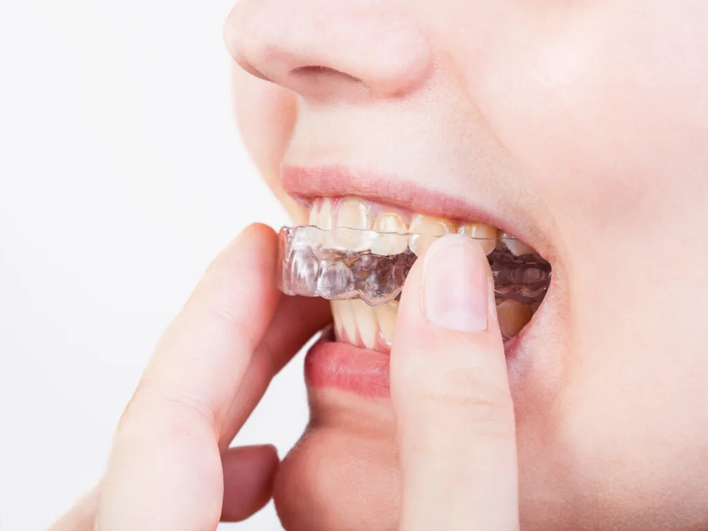 Mujer se pone alineadores en la boca - Invisalign después de ortodoncia fija: