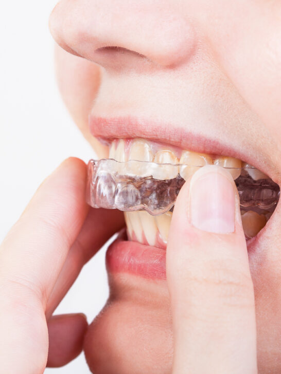 Invisalign after fixed braces: Is a change possible?
