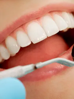 Mouth Checkup at the Dentist - White Braces