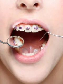 Woman with braces - Metal Braces - cost and info