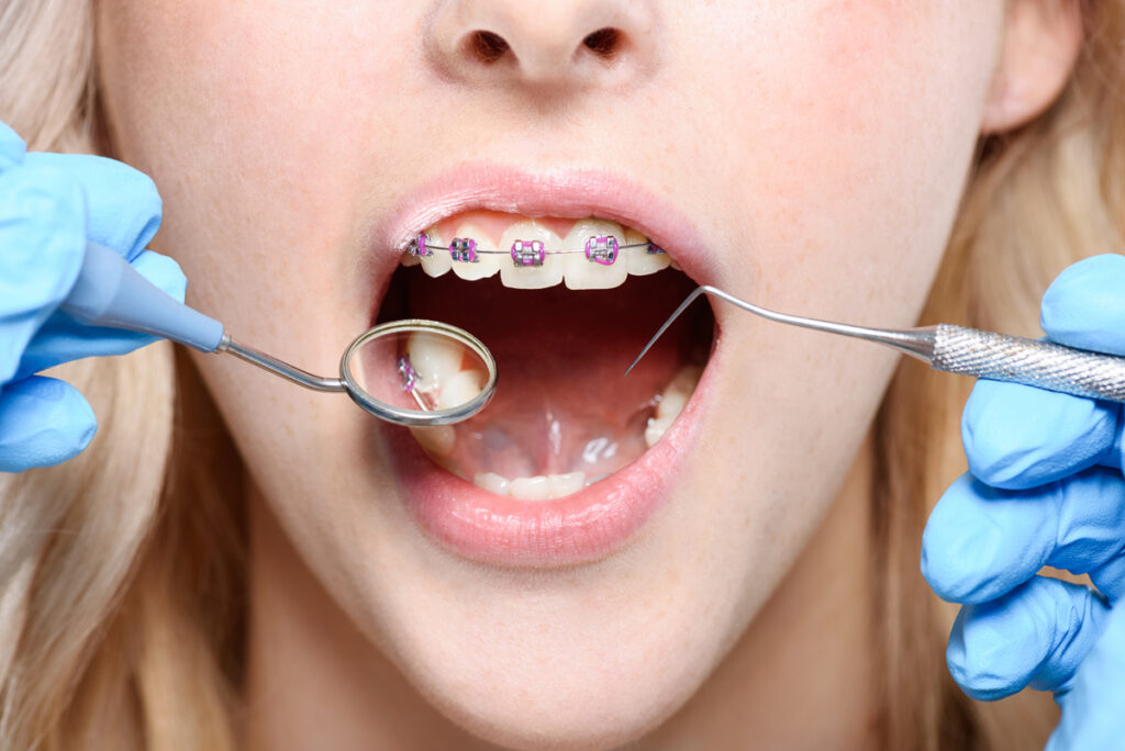 Mujer joven con ortodoncia fija en el dentista - dolor de ortodoncia