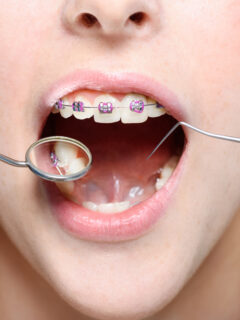 Junge Frau mit fester Zahnspange beim Zahnarzt - Zahnspange Schmerzen