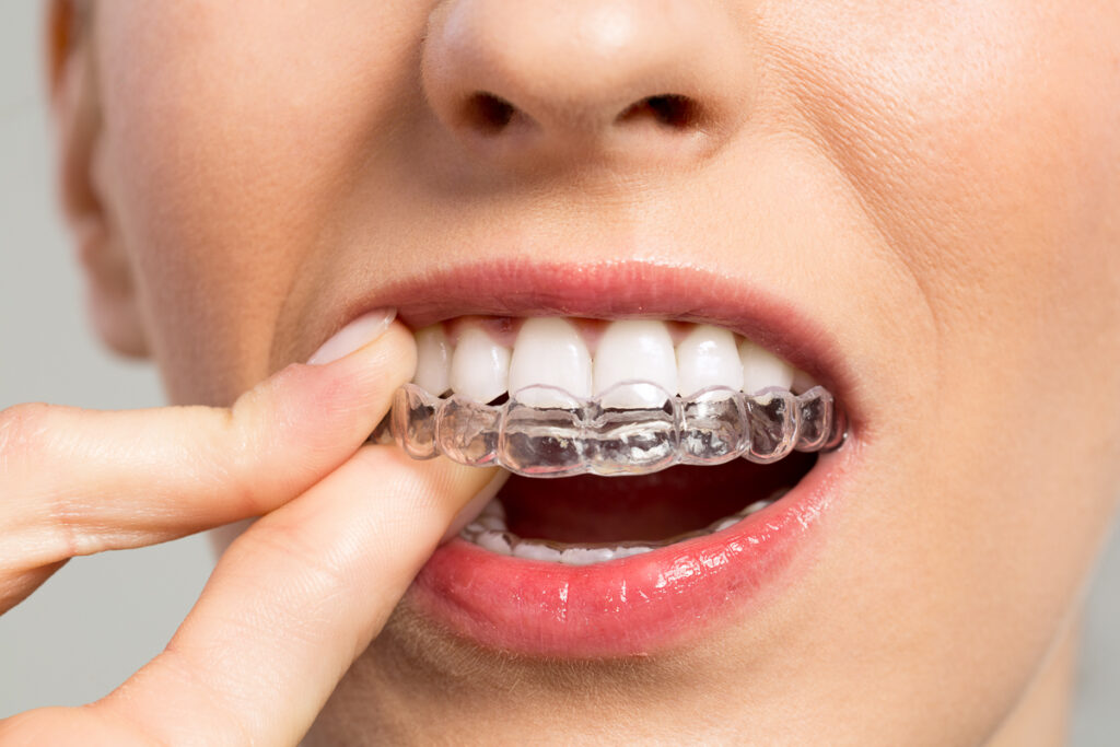 Young woman uses aligner - Can Retainers move Teeth back?
