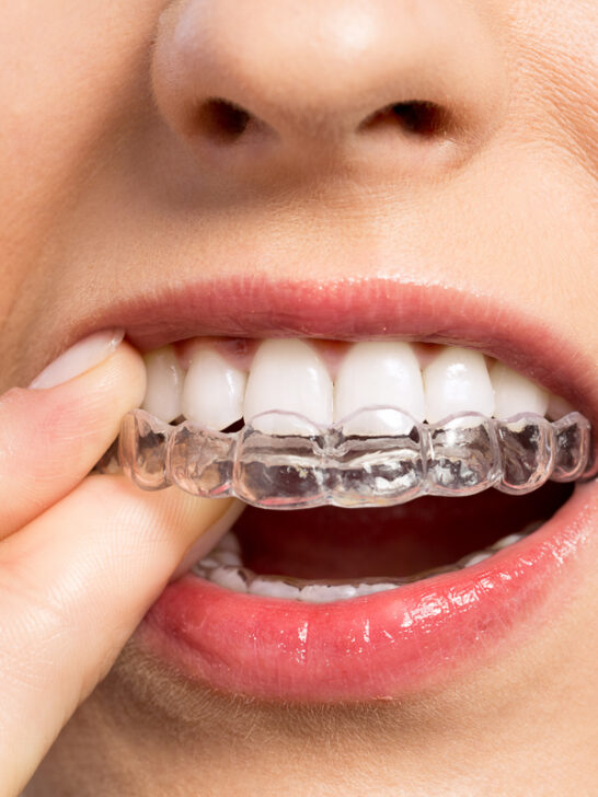 Can Retainers move Teeth back?