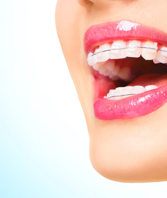 Ceramic brackets: discreet ceramic braces in transparent or tooth colored